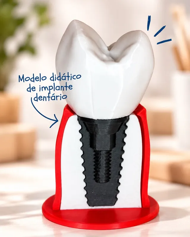 Modelo didático de implante dentário mostrando dente, pino e base